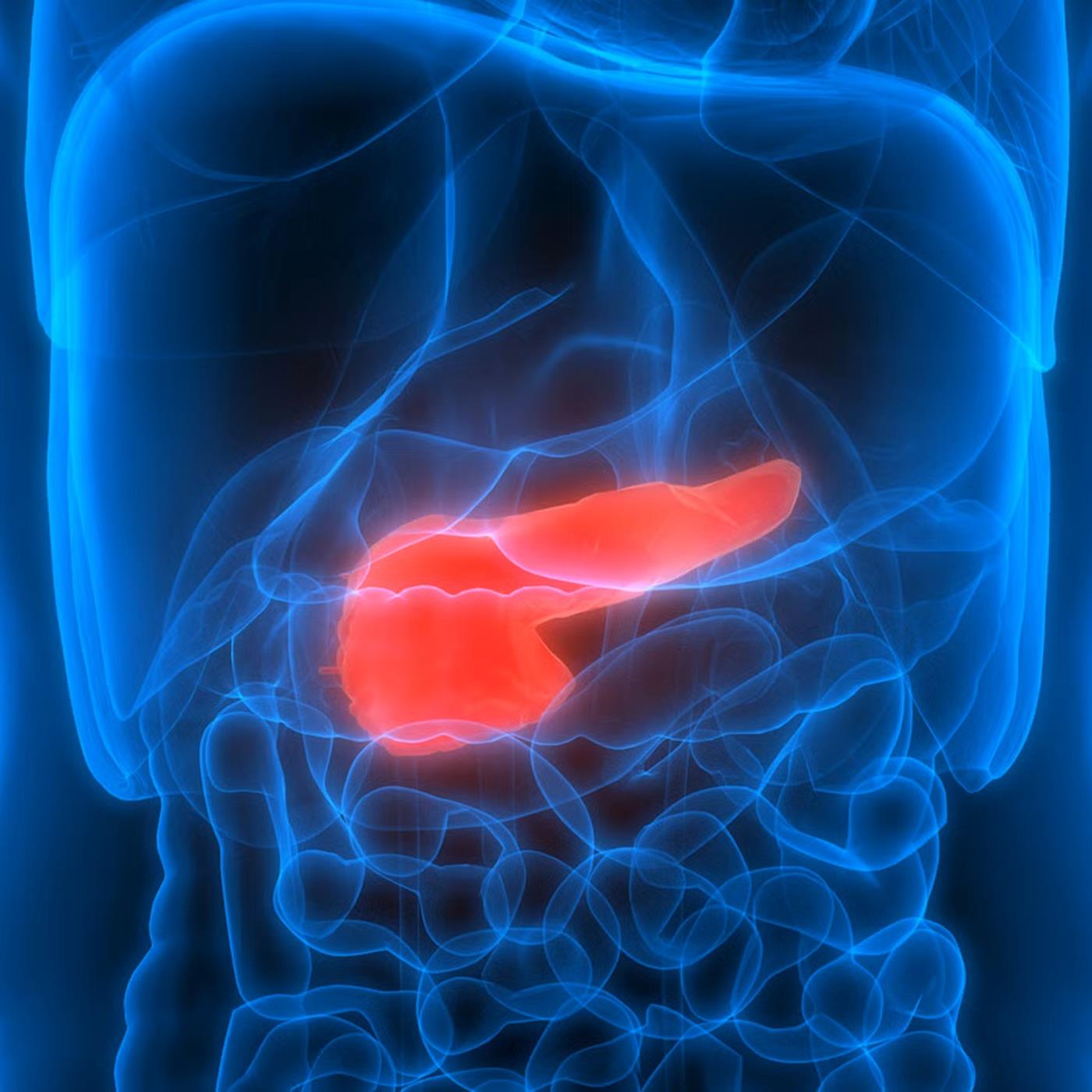 Yapay Zeka Pankreas Kanserini 1.5 Yıl Önceden Tespit Ediyor